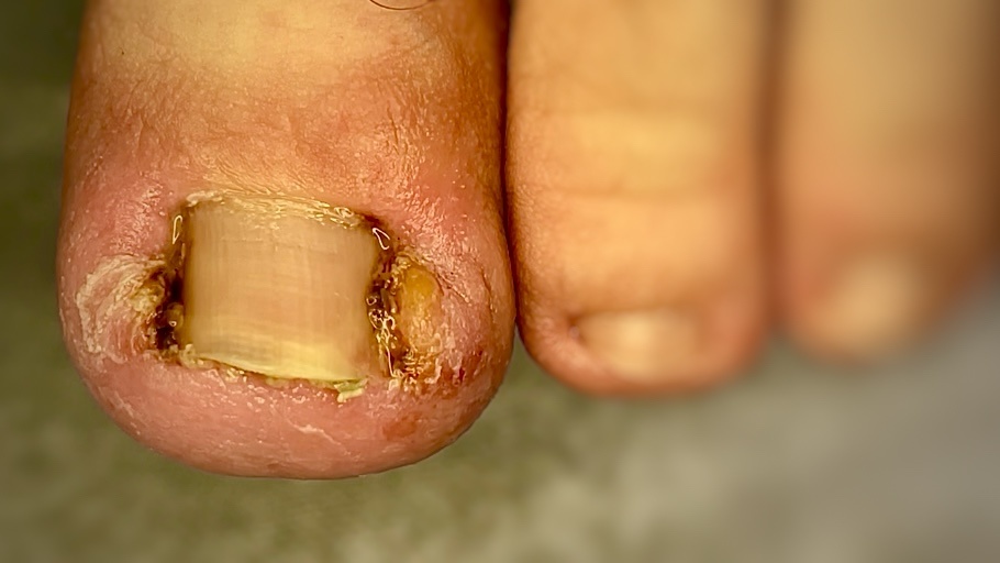 Главная причина воспаления околоногтевых тканей - чрезмерное давление деформированных боковых стенок