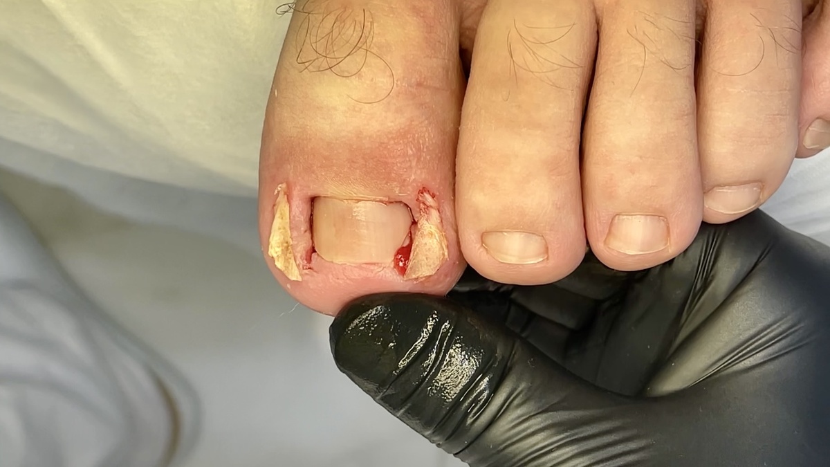 Извлечение только вросших сегментов максимально сохраняя ногтевую пластину.