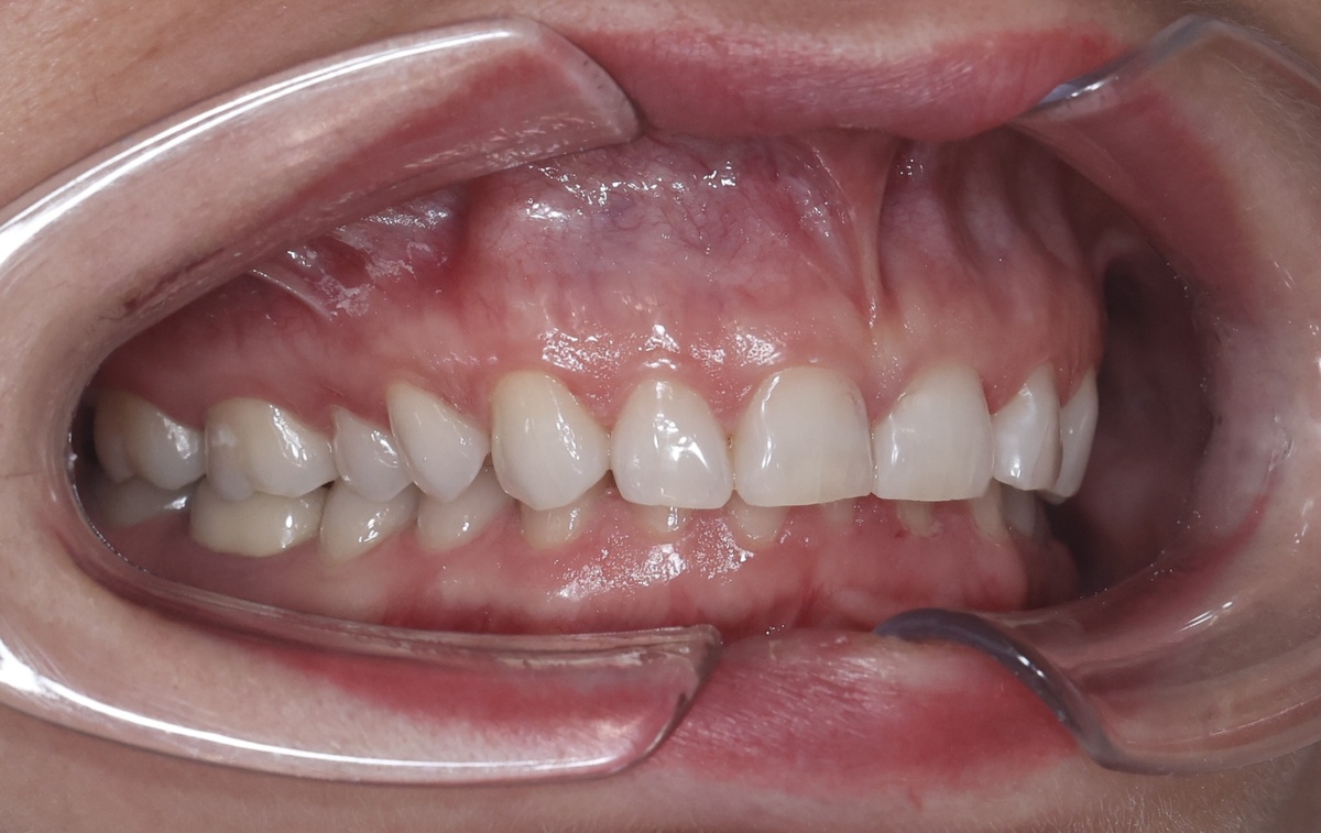 Мой прикус до исправления - жуть