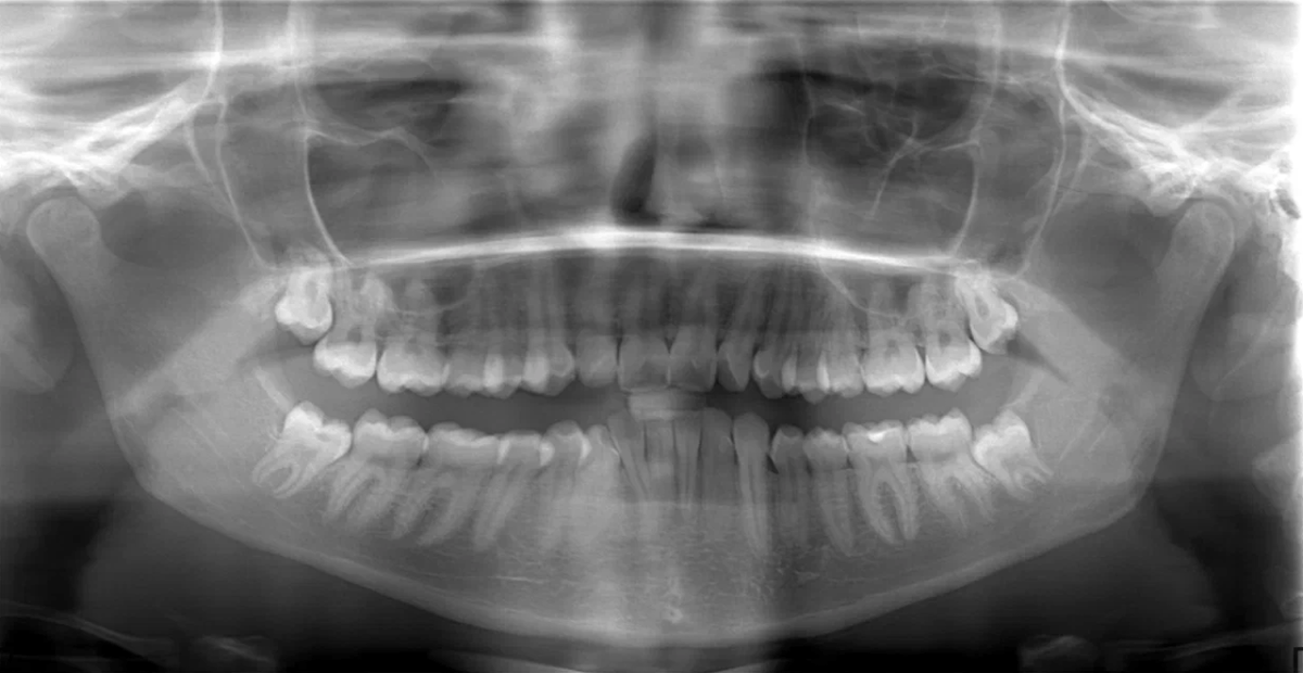 A Удаление зуба мудрости в стоматологии Пробел в Москве
