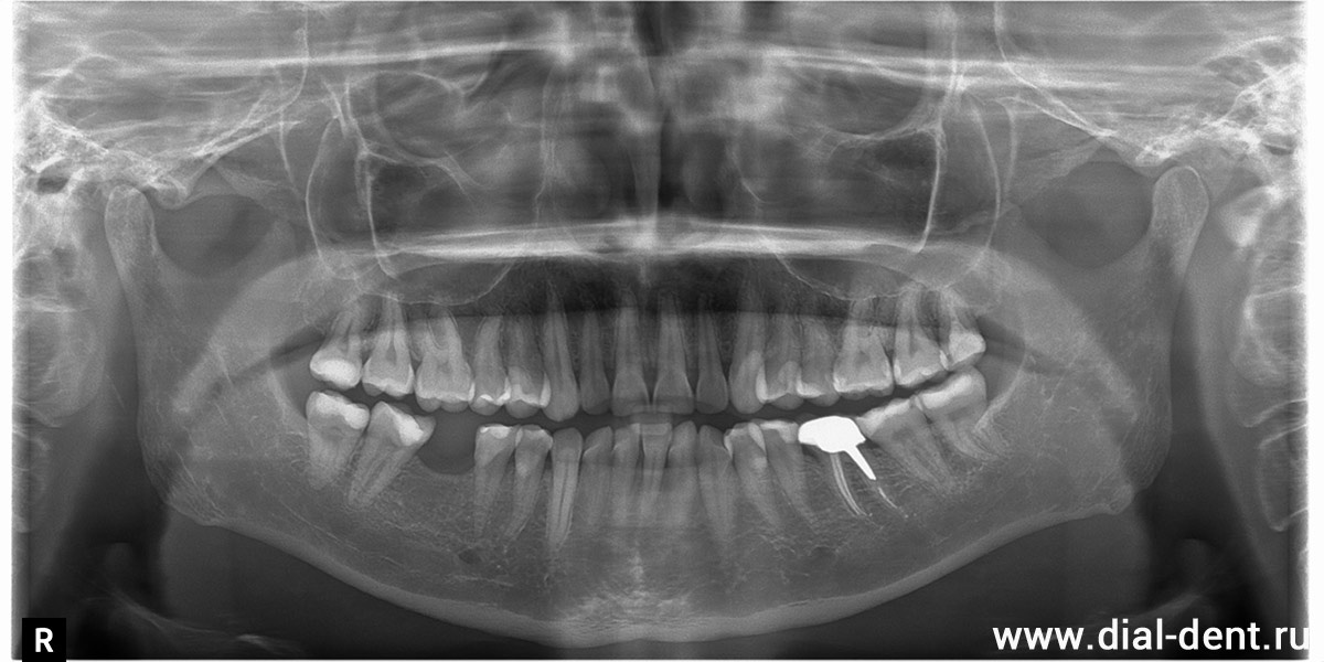 КТ зубов до начала лечения