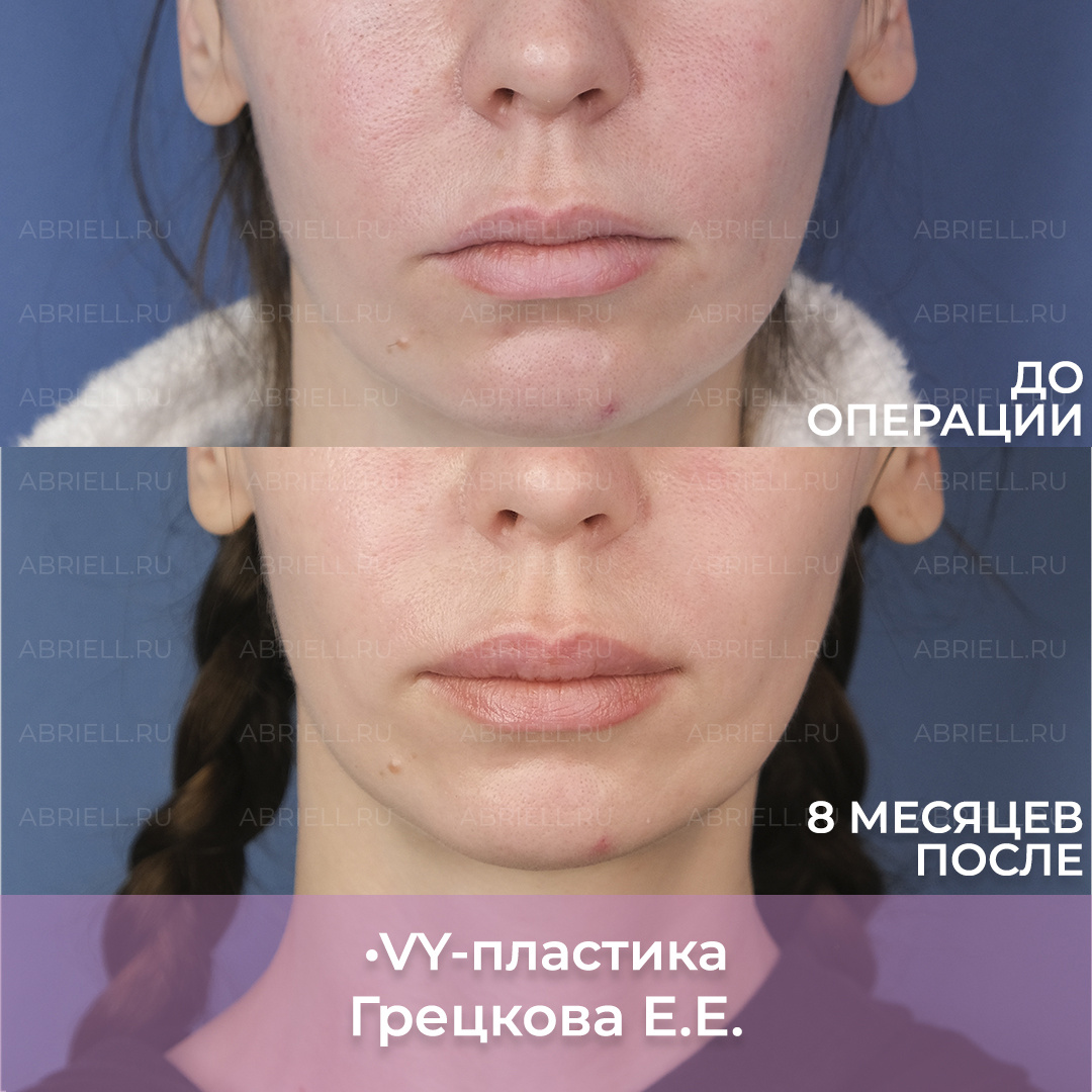 Результат увеличения губ методом vy-пластика в Санкт-Петербурге. Пластический хирург Грецкова Евгения Евгеньевна