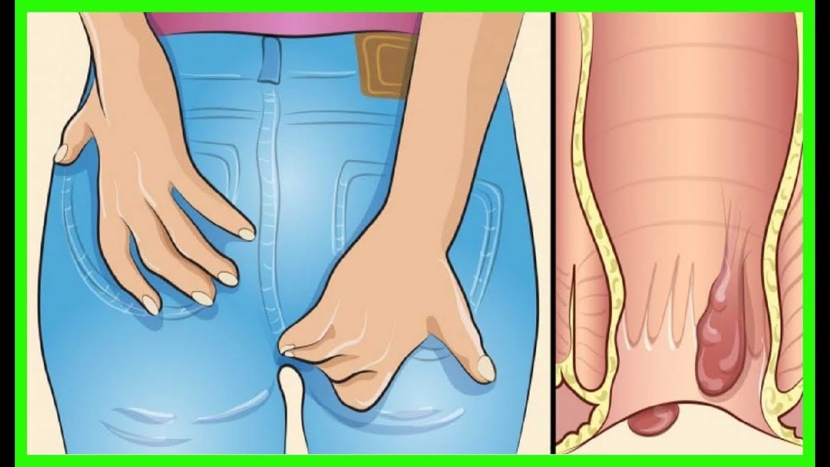 Интервью: Почему геморрой появляется даже у тех, кто правильно питается