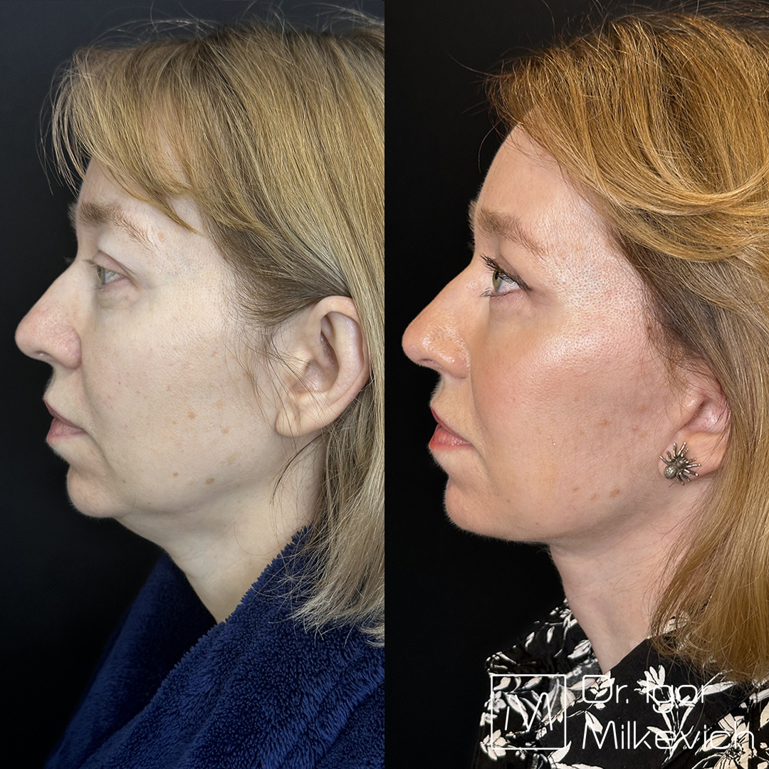 4 месяца после операции. Здесь был выполнен хирургический смас-лифтинг (подтяжка нижней трети лица)