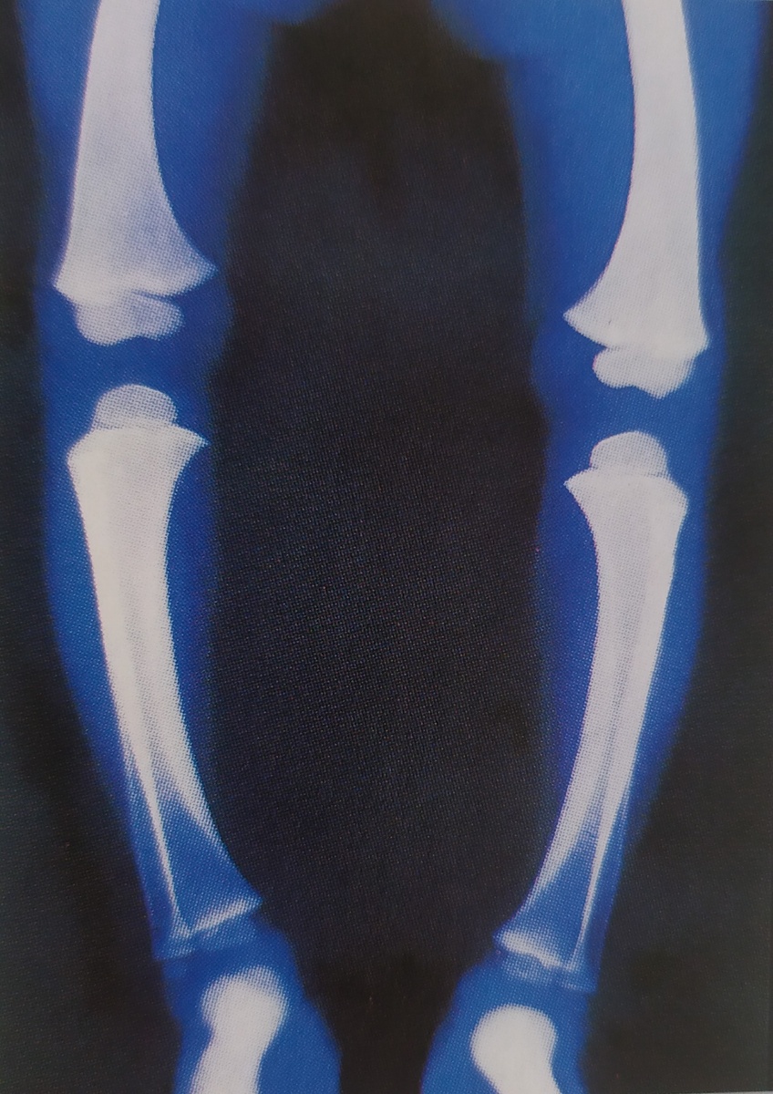 Витаминная недостаточность