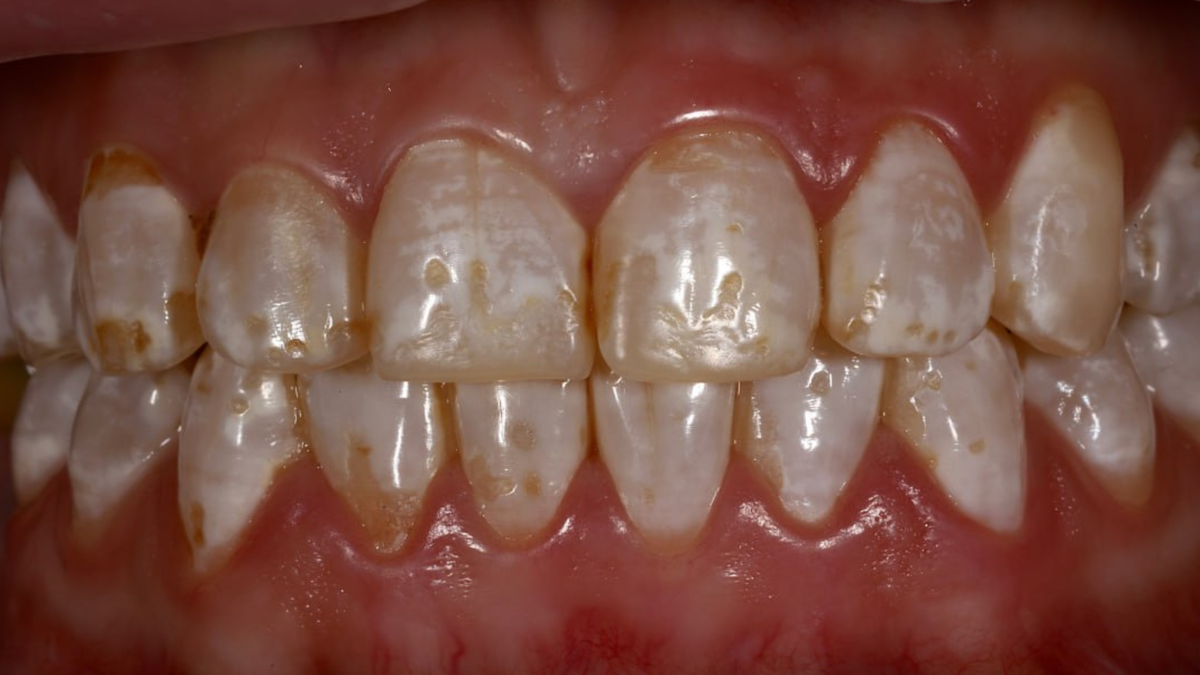 Так выглядит флюороз. 