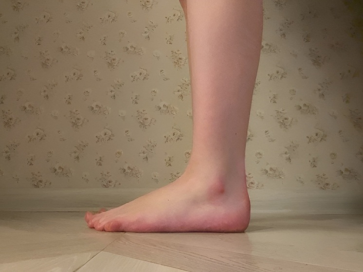     Эксперт Буры порекомендовала следить за питанием при варикозе. Фото: архив МК в Хакасии