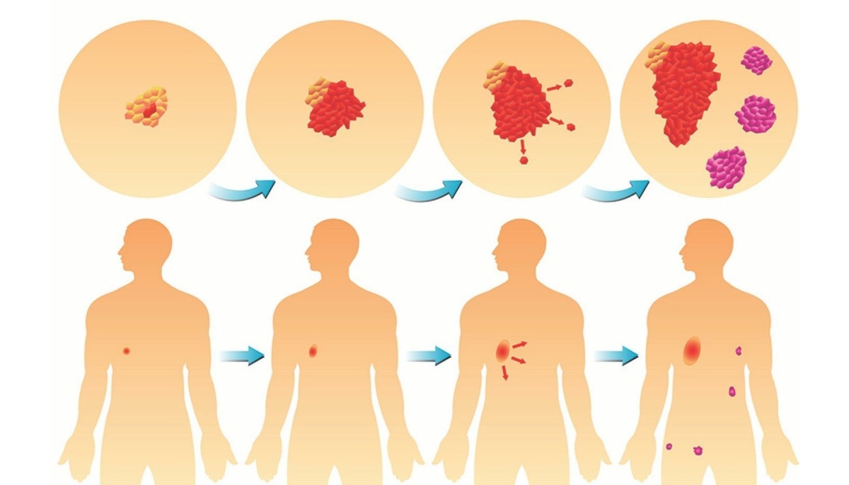 Признаки рака, которые часто путают с усталостью