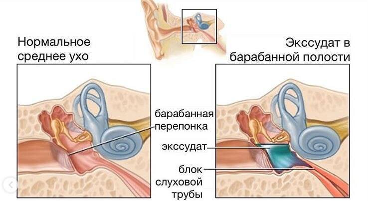 Слух восстановлен: лечение сложного экссудативного отита у ребенка