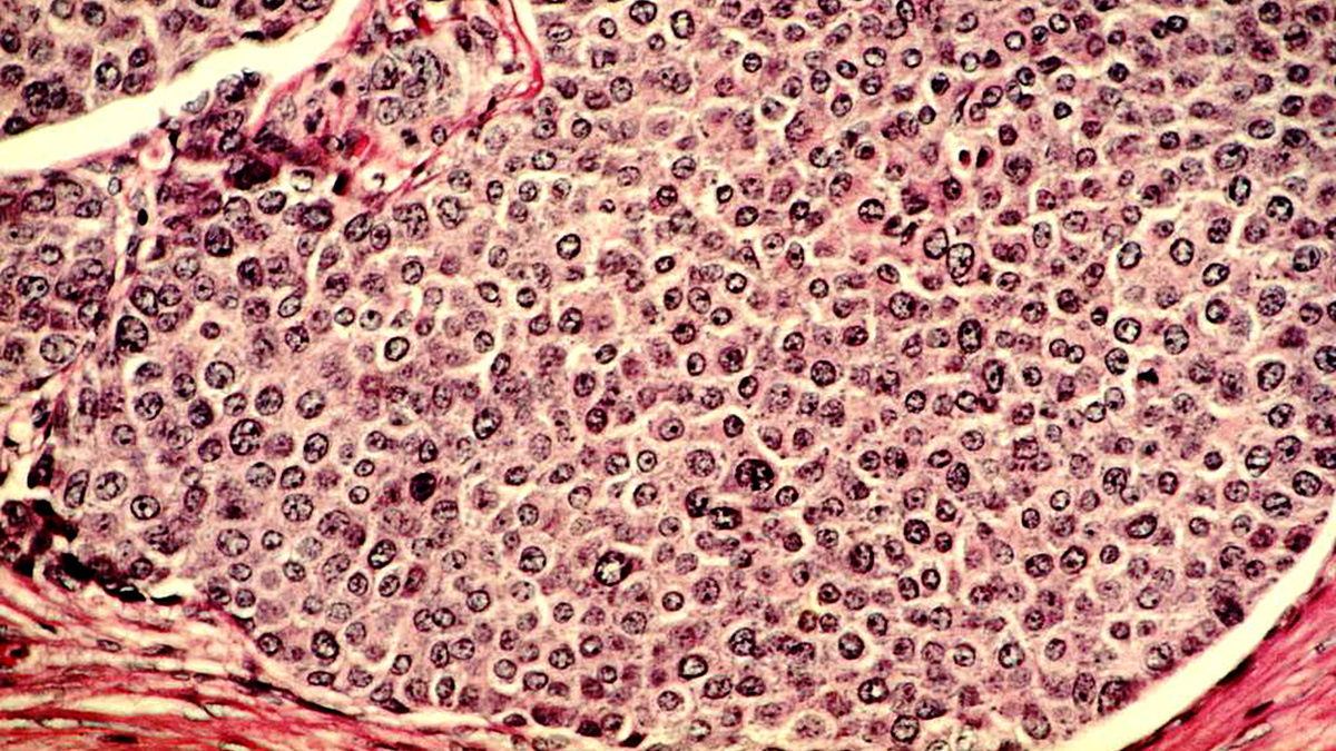 Клетки рака молочной железы. Окраска гематоксилин эозин, х100.