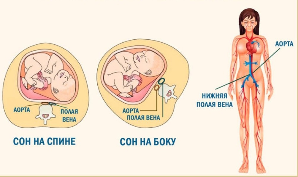 Схематично представлен механизм возникновения данного состояния и способ его профилактики 
