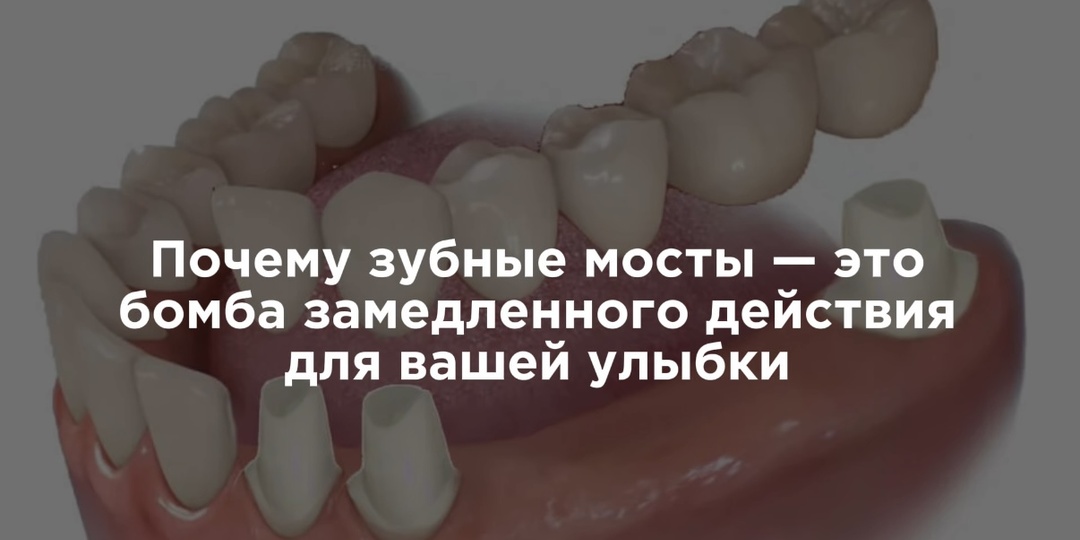 Почему зубные мосты — это бомба замедленного действия для вашей улыбки?
