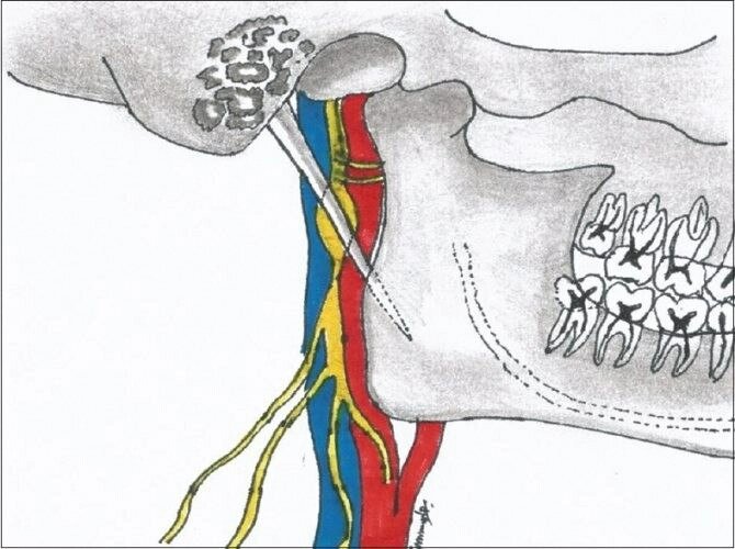    Схематичное изображение воздействия шиловидного отростка на сосуды и нервы шеи. Фото: пресс-служба Российской детской клинической больницы Минздрава России