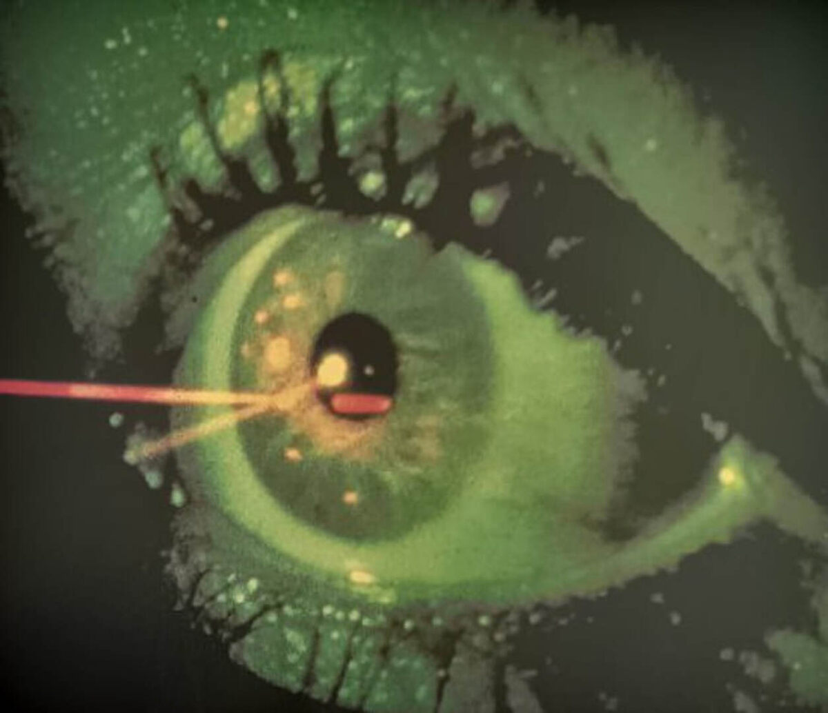 Тончайший луч гелий-неонового лазера пронизывает зрачок человеческого глаза. Он прорезает крошечное отверстие в замутненном зрачке, чтобы свет снова мог проникать в глаз.