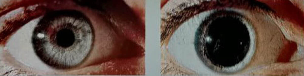 Сужение и расширение зрачка при ярком и тусклом освещении.