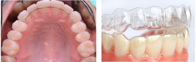 Несъемный ретейнер и ретенционная капа