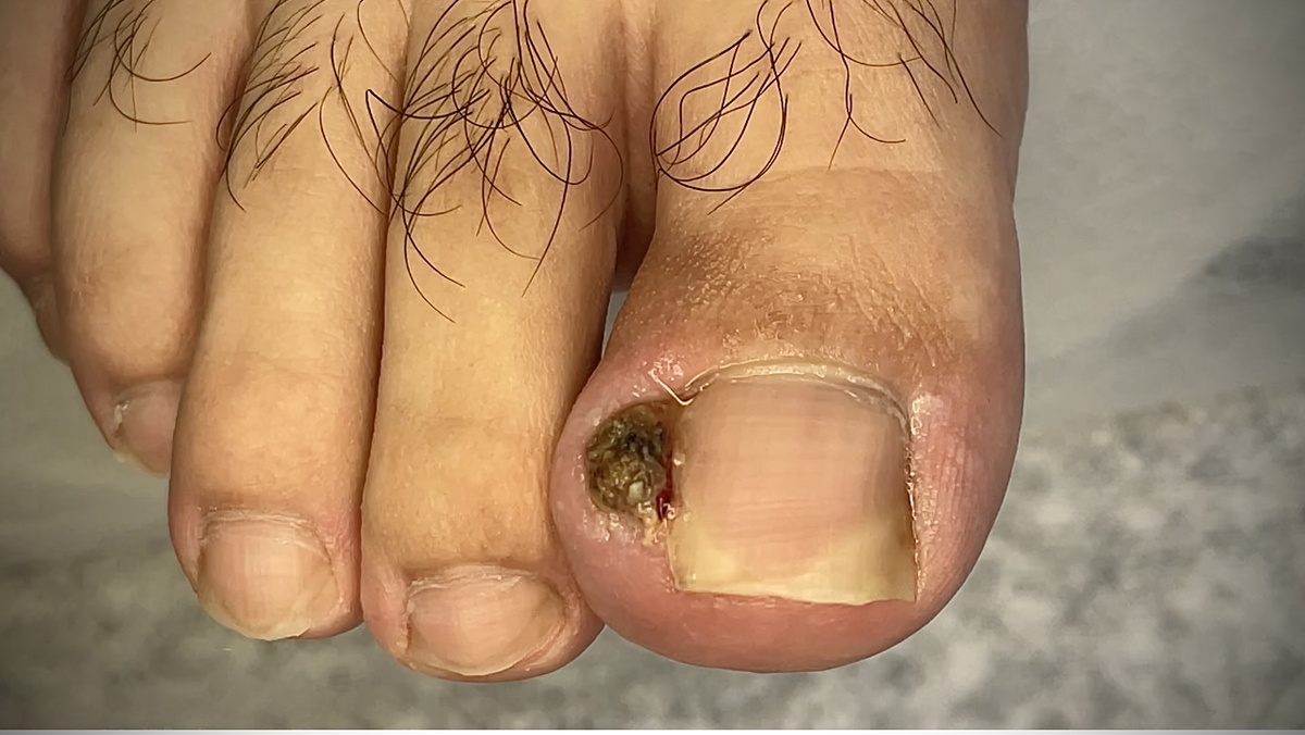 Запущенная стадия врастания ногтя