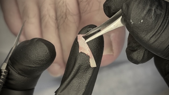 Внушительный размер вросшего сегмента