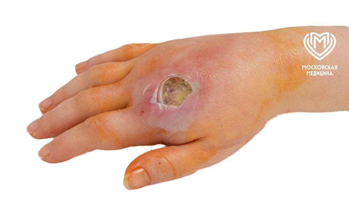    Укус кобры. Фото: Shot