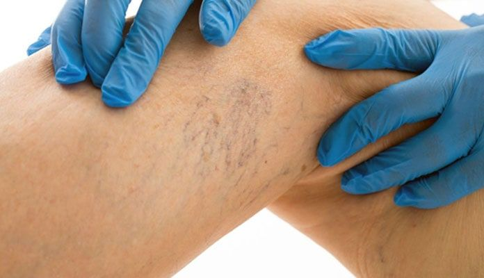 Сосудистая сеточка на ногах - проявление проблем с сердцем?