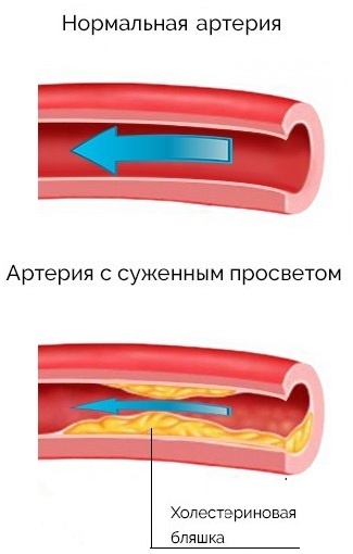 Сужение просвета артерии.