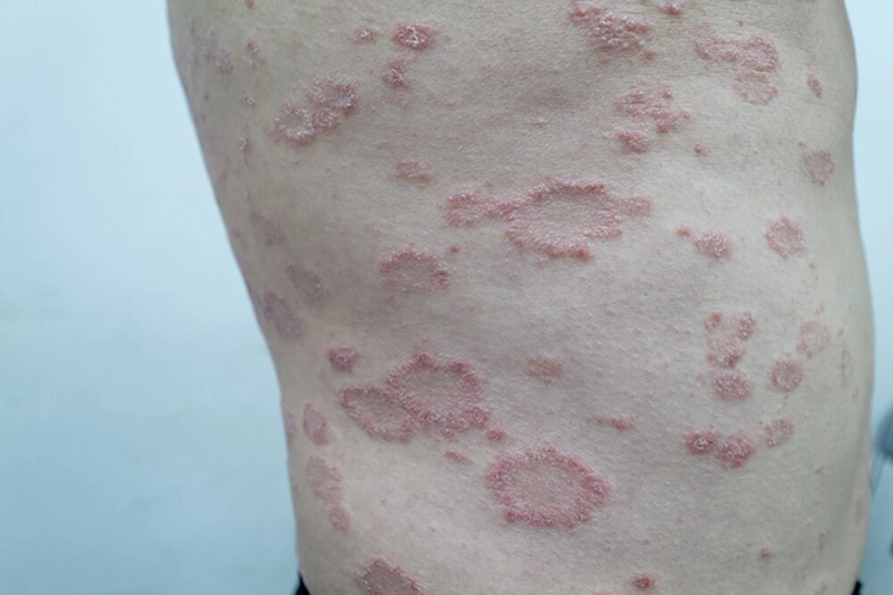    Розовый лишай. Главное — не травмировать кожу: не тереть мочалкой, не использовать спиртосодержащие средства, избегать перегрева и горячего душа. Фото: istockphoto.com