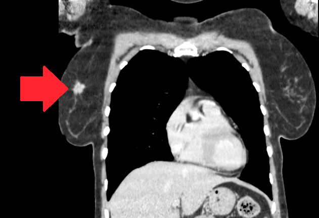 Компьютерная томография с контрастированием позволяет прекрасно визуализировать опухоль в молочной железе