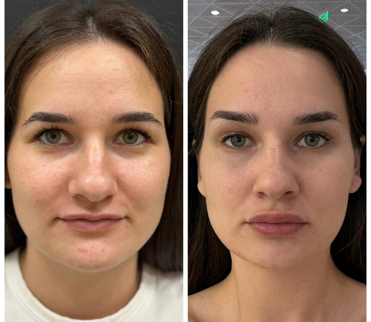 Слева - фото до, справа - через 3 недели после комплекса процедур 