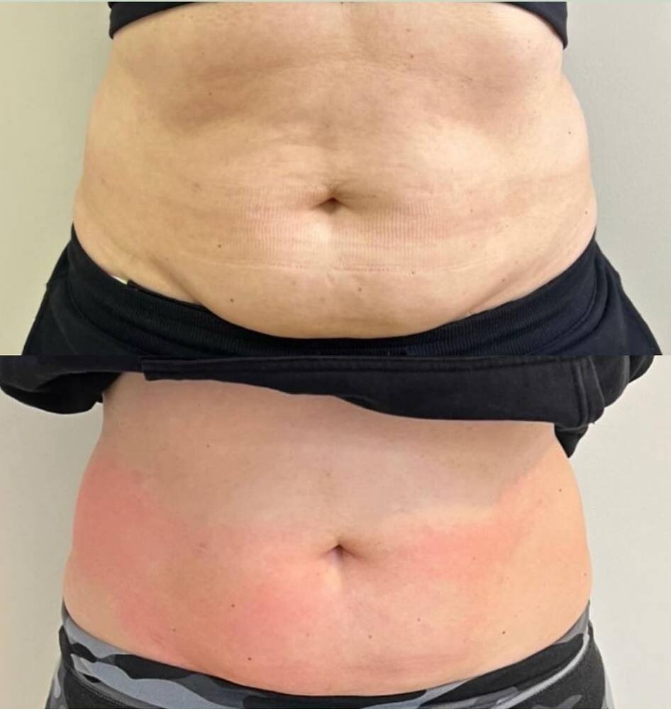 Похудение и улучшение качества кожи