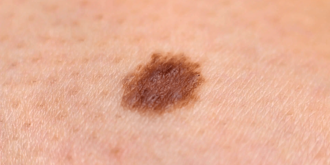 Рак Кожи — Пятна и Родинки, на Которые Нужно Обратить Внимание