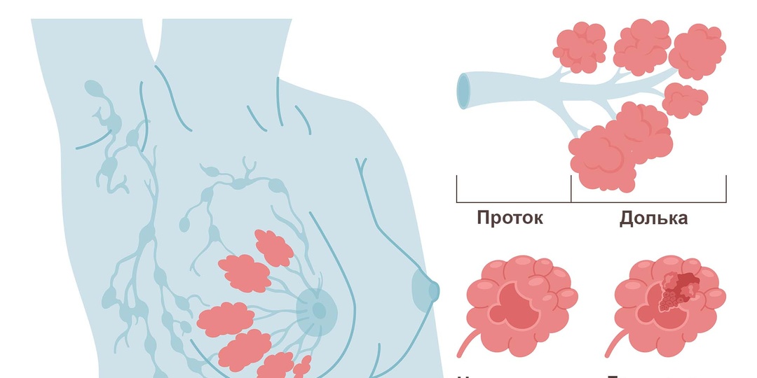 Рак молочной железы: 7 ранних симптомов. Интервью с онкологом