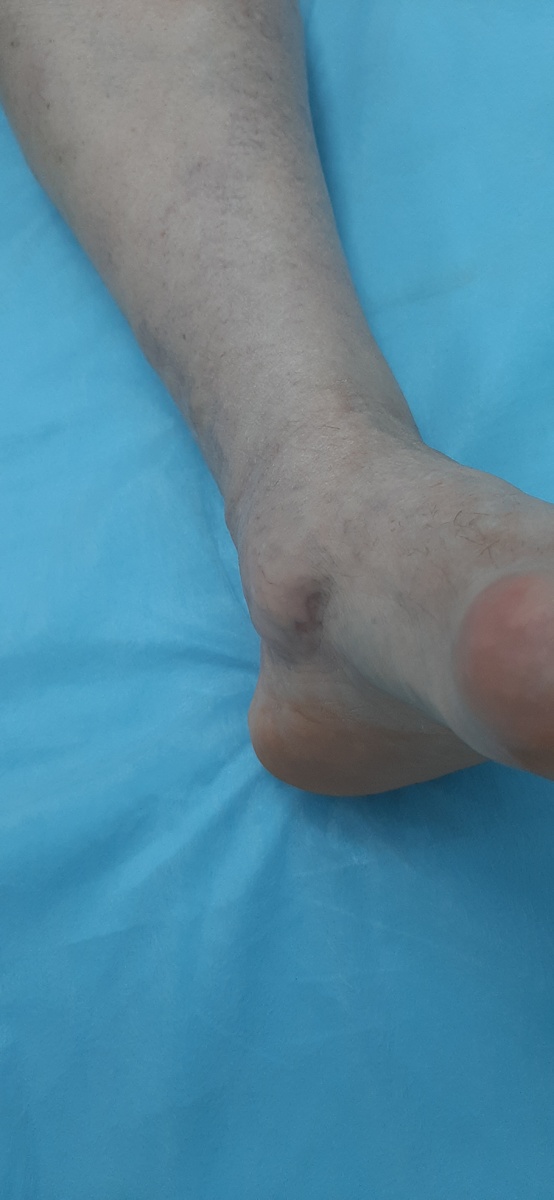 На представленных фото состояние перед операцией. Новообразование расположено под кожей на внутренней поверхности левой стопы и достаточно хорошо видно. На первый взгляд может показаться, что это никакая не липома, а внутренняя лодыжка. Но нет, увы, липома есть, проверено.