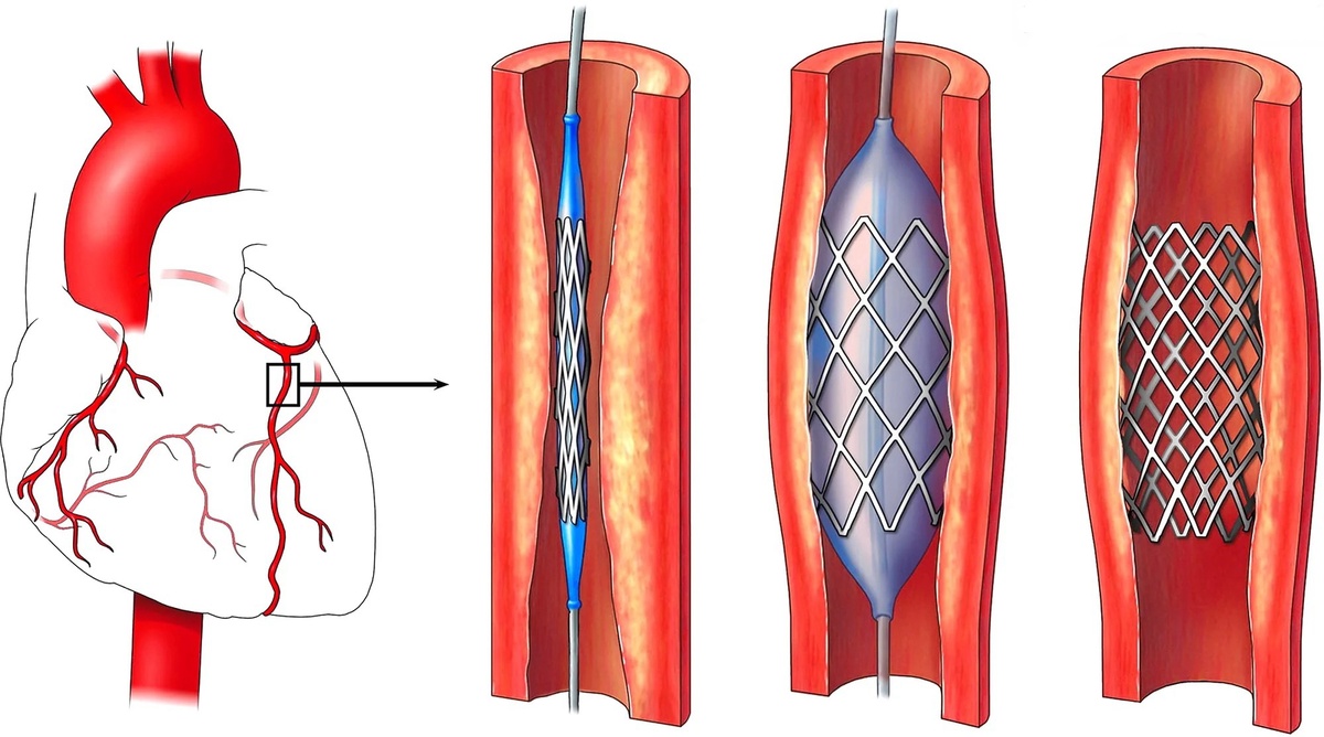Чрезкожная транслюминальная коронарная ангиопластика с установкой стента в просвет закупоренного бляшкой сосуда