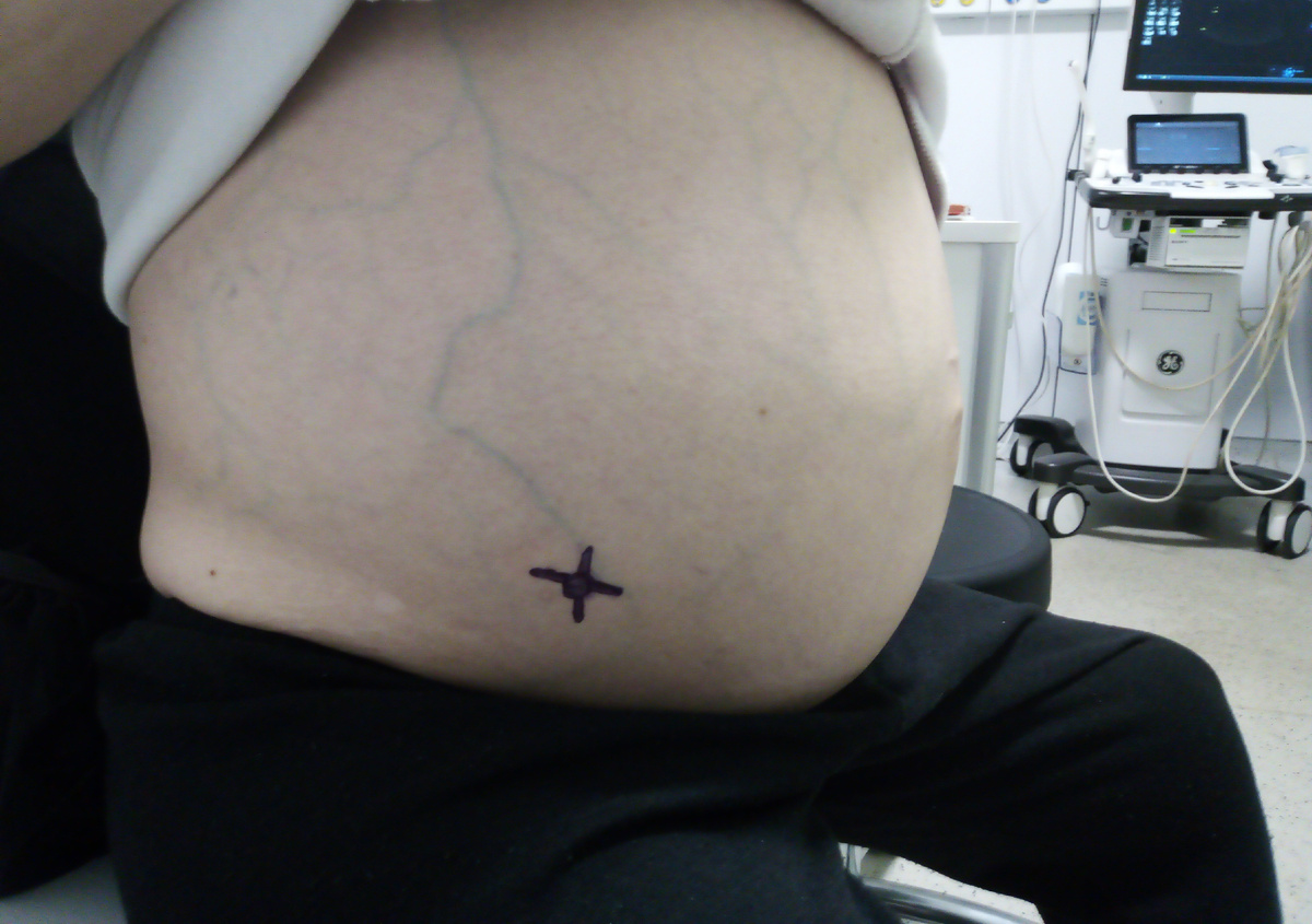 Пометили место прокола на животе