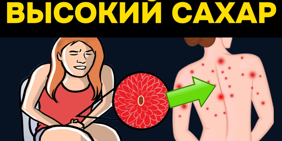 7 неприятных признаков, которые указывают на то, что уровень сахара в вашей крови слишком высок