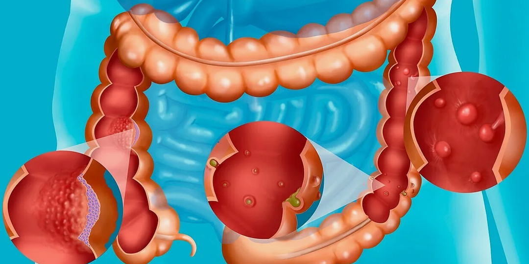 Рак кишечника: первые «немые» признаки