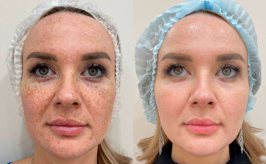 удаление пигментных пятен в клинике СкинМед (Казань)