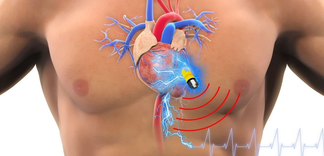 Что нужно знать о кардиостимуляторах
