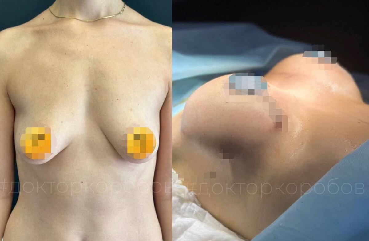 Подтяжка груди с установкой  круглых имплантов объемом 225 мл. Результат сразу после операци