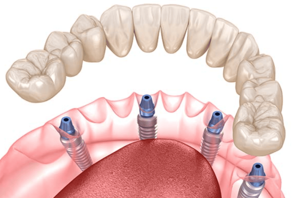 Имплантация все на 4