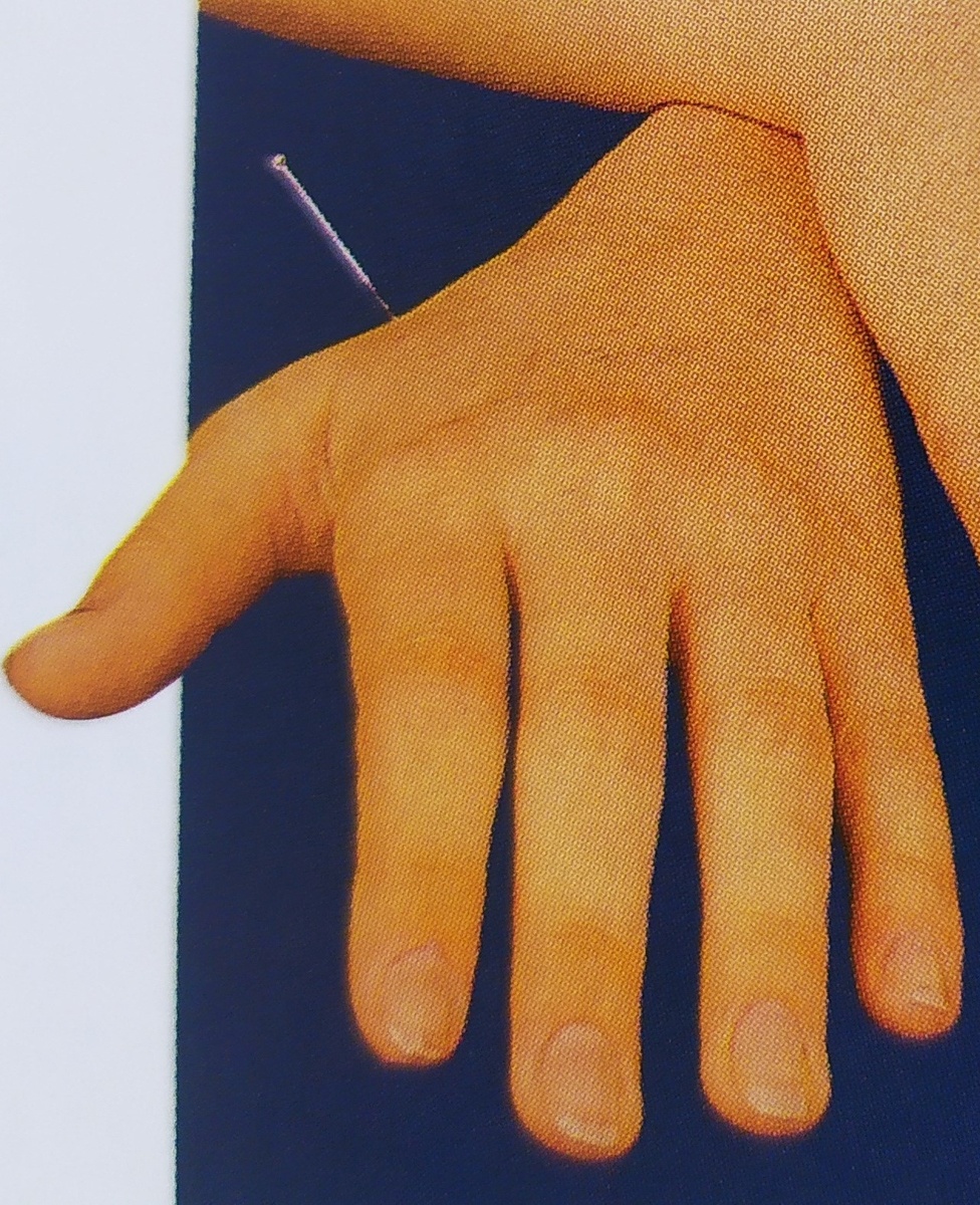 Сеанс иглоукалывания