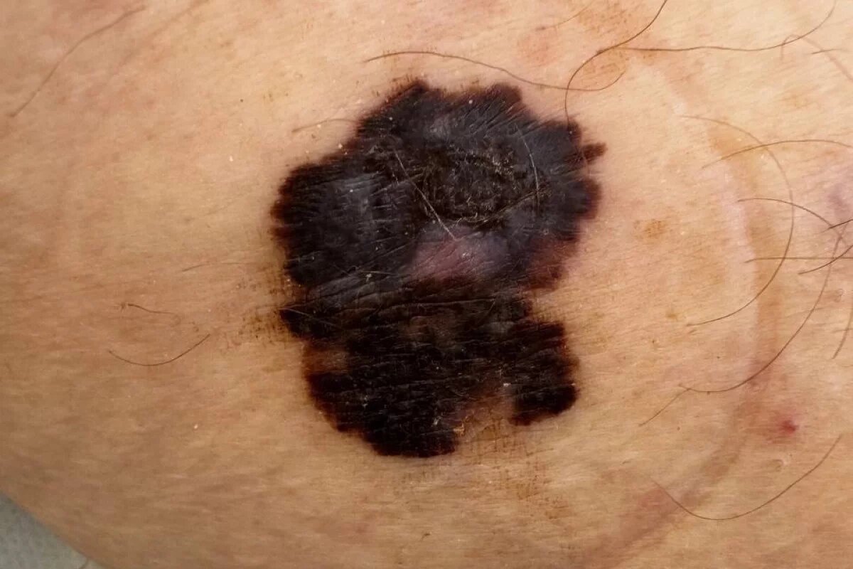    Родинка на теле псковички за несколько лет переродилась в меланому