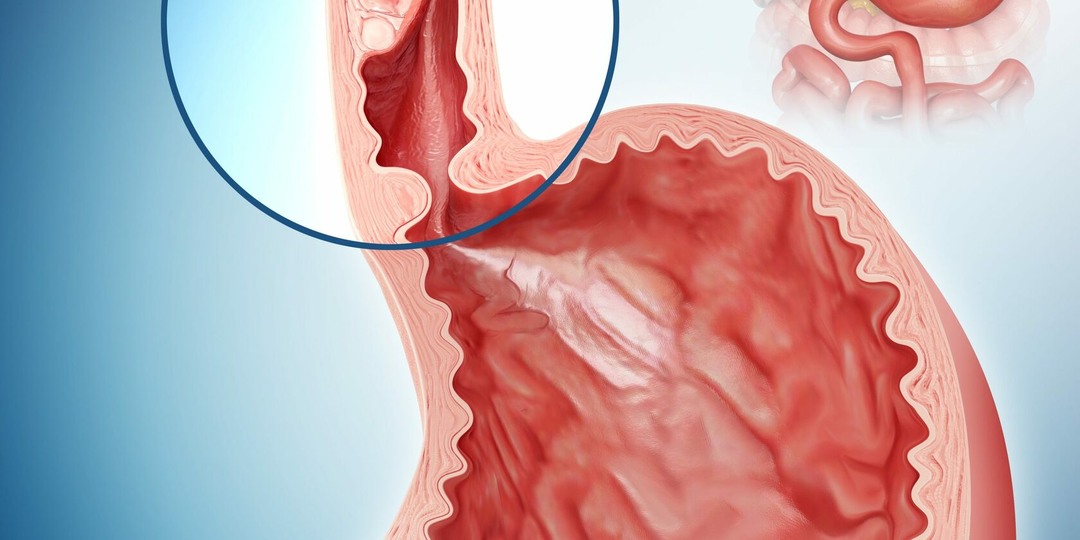 Рак пищевода: симптомы, которые легко спутать с гастритом