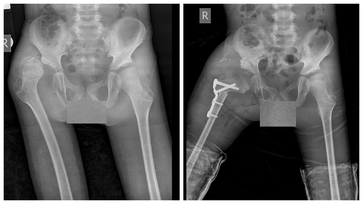 Реконструктивная операция на правом тазобедренном суставе по поводу вывиха и дисплазии вертлужной впадины: деротационно-варизирующая остеотомия в сочетании с  ацетабулопластикой по San Diego 
