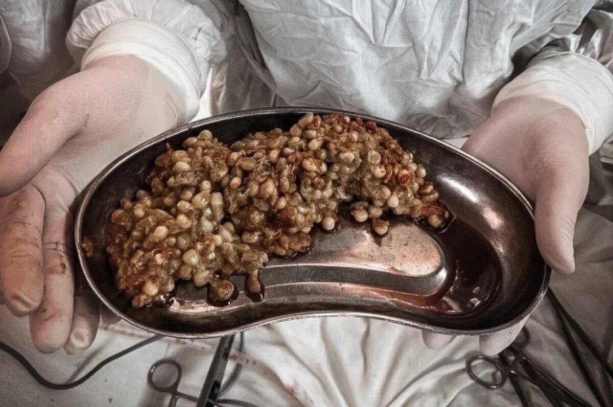    На Кубани хирурги удалили из желудка пациентки непереваренную кукурузу