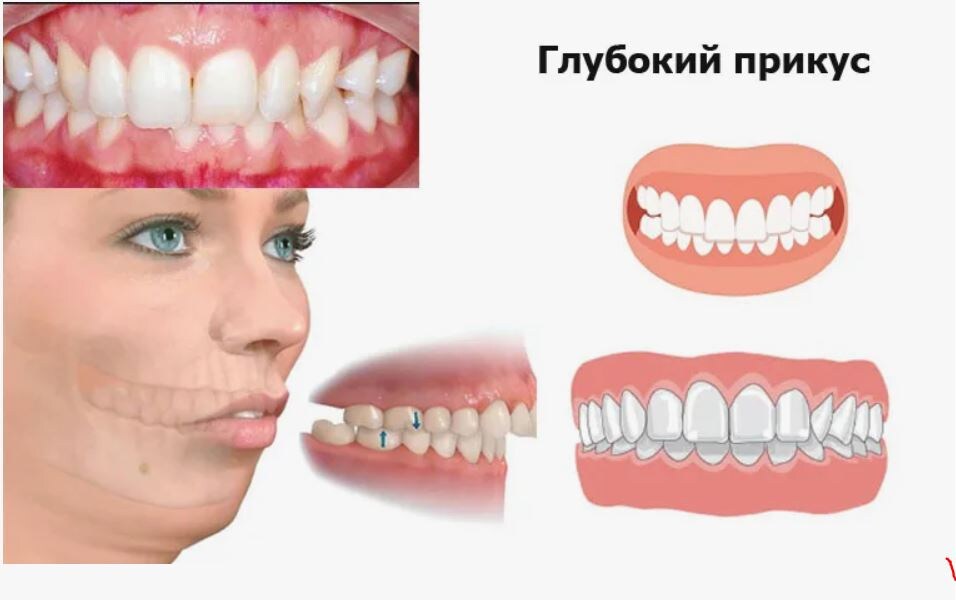 Стоматология Премоляр
