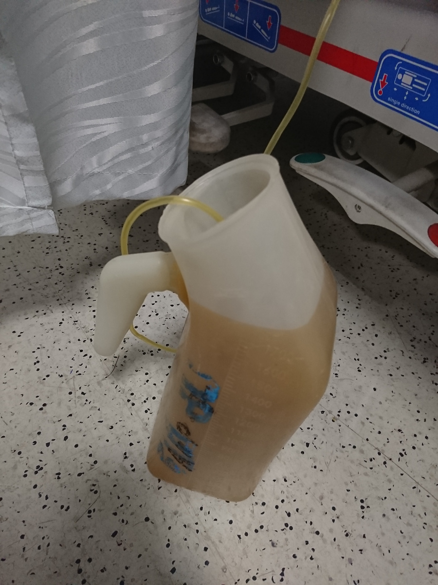 Асцитическая жидкость