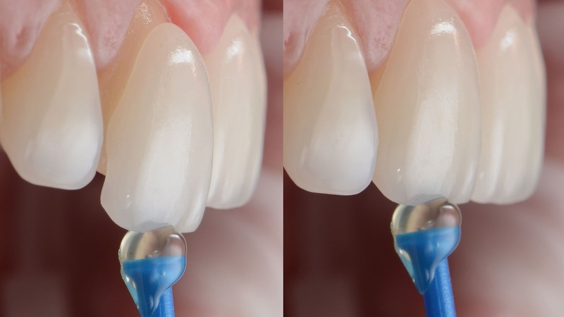 Стоматология Премоляр