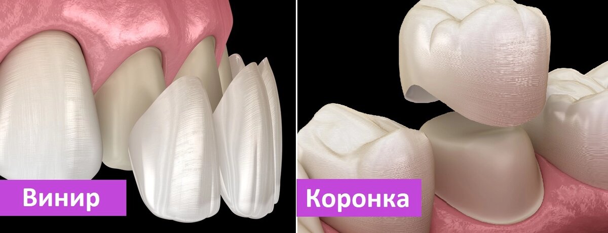 Стоматология Премоляр