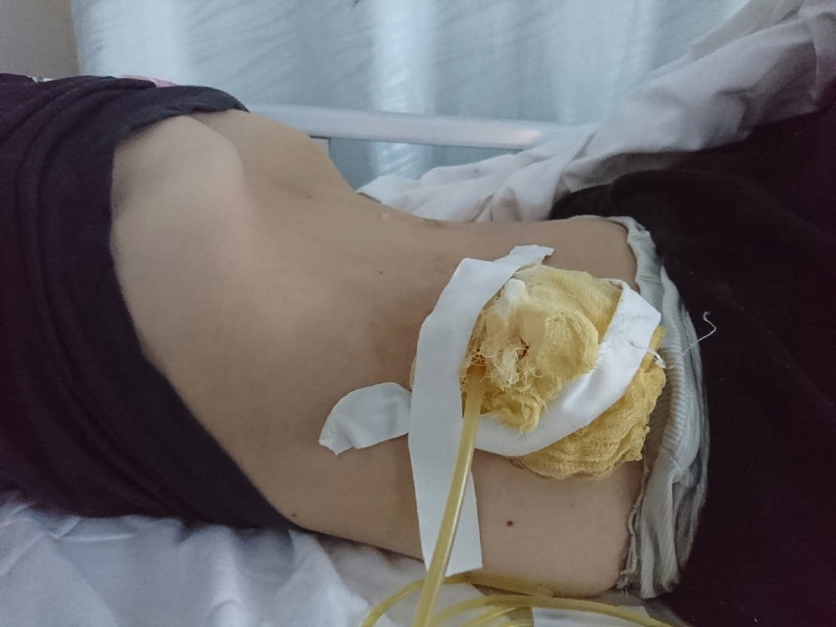 Живот после лапароцентеза